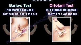 Barlow & Ortolani test Congenital Hip Dislocation- Everything You Need To Know - Dr. Nabil Ebraheim