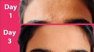 ACNE Treatment At Home  3 day Acne REMOVAL Challenge  Acne Treatment Ayurvedic with Results