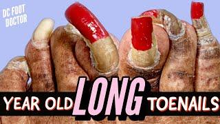 Year Old Long Toenails Trimming Extremely Long Toenails