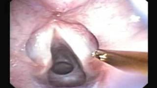 Endoscopic Laser Surgery for Subglottic Stenosis