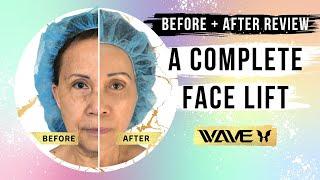 SMAS Facelift Before and After Amazing Full Face Transformation  Wave Plastic Surgery