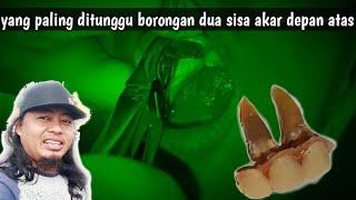 Video Yang Paling Ditunggu Proses Pencabutan Borongan Sisa Akar Gigi Depan Atas