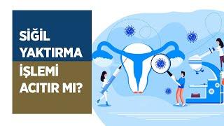 Siğil Yaktırma Nedir? Siğil Yaktırma İşlemi Acı Verir mi? - Doç. Dr. Aydın Köşüş