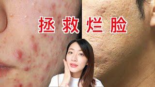痘痘痘疤有救了！日本美容師告訴你祛痘就是這麼簡單