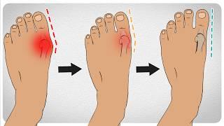How to Fix Bunions in 5 Steps