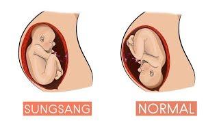 Posisi Bayi Sungsang ? Begini Cara Mengubah Posisi Bayi Sungsang Menjadi Normal 