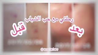 رحلتي مع حَب الشباب، my acne journey