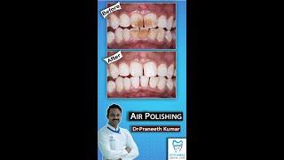 How Teeth Are Cleaned At The Dentist Painlessly - Contactless Air Polishing Technology. #Shorts