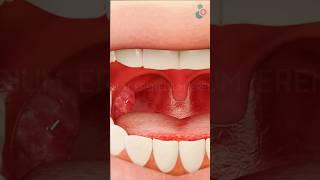 Tonsil Removal Surgery ↪ 3D Medical Animation #Tonsil #Tonsillectomy #Surgery #Shorts