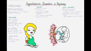 Hypertensive Disorders in Pregnancy - Preeclampsia Eclampsia Gestational Hypertension