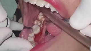 Plaque removed  Tartar buildup removal