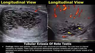 Scrotal Ultrasound Reporting  Scrotum Testis & Epididymis Pathologies  How To Write USG Report