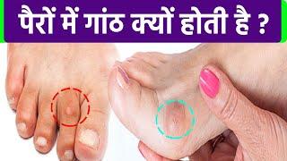 पैरों पर गांठ क्यों होती है। पैरों की गांठ ठीक करने का उपाय । Remedy for lump on foot। Boldsky