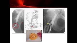 Femoral Access and Femoral Vascular Closure