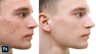 How To Clean Up Skin Remove Acne Blemishes & Scars In Photoshop