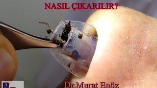 Silikon Burun Tamponu Nasıl Çıkarılır? Nasal Splint Removal