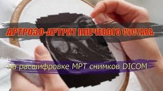 ЖИДКОСТЬ в плечевом суставе АРТРОЗО-АРТРИТ и ИМПИДЖМЕНТ-СИНДРОМ плеча на расшифровке МРТ 2 мнение