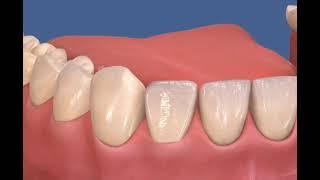 Traitement Gingivite Parodontite  Parodontal disease