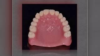 Протезирование при полном отсутствии зубов  СЦ «Дентика»