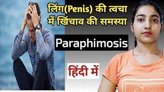 What is paraphimosisParaphimosis reductionparaphimosis causes and symptomstreatment