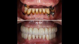Протезирование всех зубов