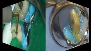 Surgical and non surgical Endodontic treatment with MoraVision