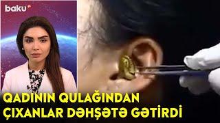 Qadının qulağından çıxanlar dəhşətə gətirdi - Maraqlı anlar  BAKU TV