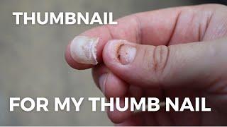 Smashed Nail Falling Off - Subungual Hematoma Time Lapse