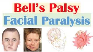 Bell’s Palsy Facial Paralysis  Causes Pathophysiology Signs & Symptoms Diagnosis Treatment