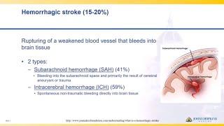 Hemorrhagic Stroke  Lisa Klein