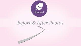 Phorests Before & After Photos