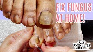 Toenail Fungus Cleaning at Home Success