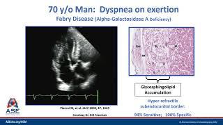HCM Microlesson Case Example #4 The Walls of the Heart are Thick – Case of Fabry’s Disease