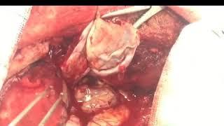 خارج کردن کامل تومور گلیوم مغزی در بیمار۳۸ساله دکتر مسعود اصغری نوسری