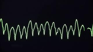 Cardiac arrest rhythms VF VT Asystole and PEA