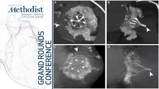 Transcatheter Mitral Valve Replacement The Journey Mayra E. Guerrero MD June 2 2022