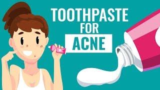Is Using Toothpaste For Acne safe?  Know the Truth