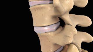 Back Pain Lumbar Disc Injury