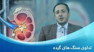 دکتور رحیم الله سلطانی  تداوی سنگ های گرده  Kidney stone disease