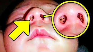 Mother Notices Holes in Babys Nose  Doctors Discover Something Troubling