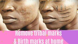 How to remove tribal marks at home