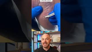 Doctor reacts to corn callus removal #footcorn #dermreacts #doctorreacts