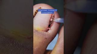 Ingrown toenail treatment  #shorts