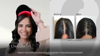 Over the years Capillus has helped thousands of people fight hair loss.