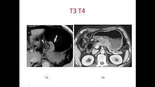 Surgery for Gastric Cancer_Dr Sumit Sanyal