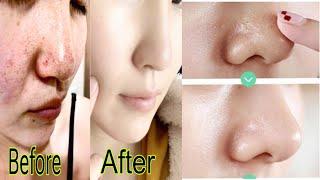 Open Pores 4 Home Remedy For Oily Skin How To Close Open Pores On Face At Home open pores minimise