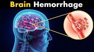 What Happens in Brain hemorrhage?  Symptoms Causes and Treatment 3d animation