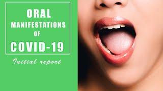 Oral manifestations of Covid-19
