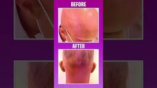 Hair Transplant Before and After Results  #shorts #ytshorts #hairtransplant #haircareroutine