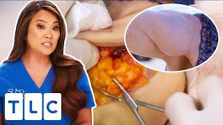 Dr Lee Removes Big Lump That’s Been On A Woman’s Arm Since The 80s  Dr Pimple Popper  UNCENSORED